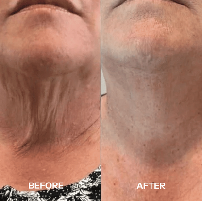 Dealing With Wrinkles, Sagging Skin, or Lines on Your Neck? Get a Visibly Younger-Looking Neck  in Just 3 Hours