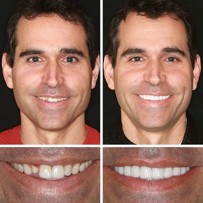 ⏰Ends Today: 50% OFF!  🏆2026 Bestselling Product🦷 Fit for a Fresh Smile, Say Goodbye to Wearing Discomfort!🌎